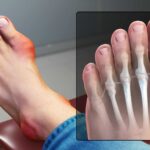 Gout Disability