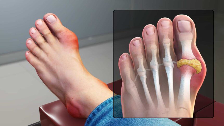 Gout Disability